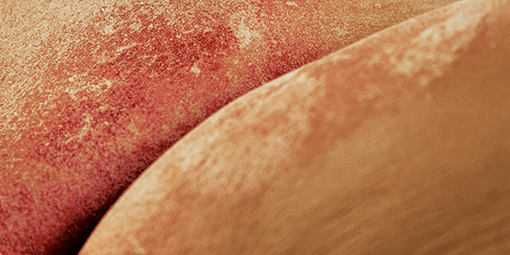 Zapalenie skóry związanie z nietrzymaniem moczu lub pieluszkowe zapalenie skóry u dorosłych objawiające się zaczerwienioną skórą. Zapalenie skóry związanie z nietrzymaniem moczu lub pieluszkowe zapalenie skóry u dorosłych objawiające się zaczerwienioną skórą.